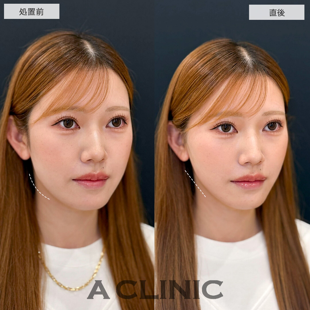 Aスレッドとあごへのヒアルロン酸注入を組み合わせて理想のVフェイスへ!こちら処置前と直後の症例です(20代女性)