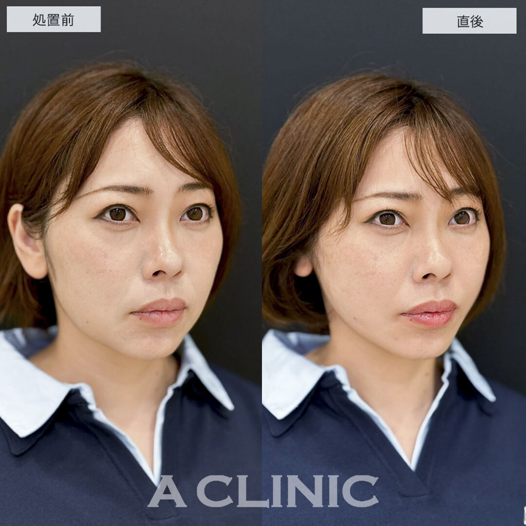 Aスレッドでナチュラルにたるみをリフトアップ!こちら処置前と直後の症例です(30代女性)