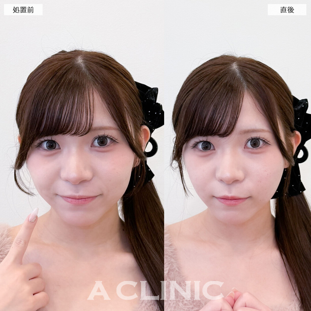 Aスレッドでキュッと引き締まった理想の小顔へ！こちら処置前と直後の症例です(10代女性)