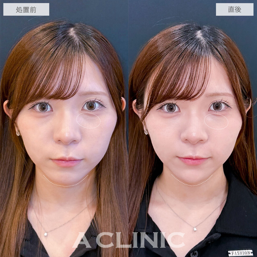 ヒアルロン酸カスタマイズメニューで中顔面の影をリセットしアゴもシャープに整えました！こちら処置前と直後の症例です(20代女性)