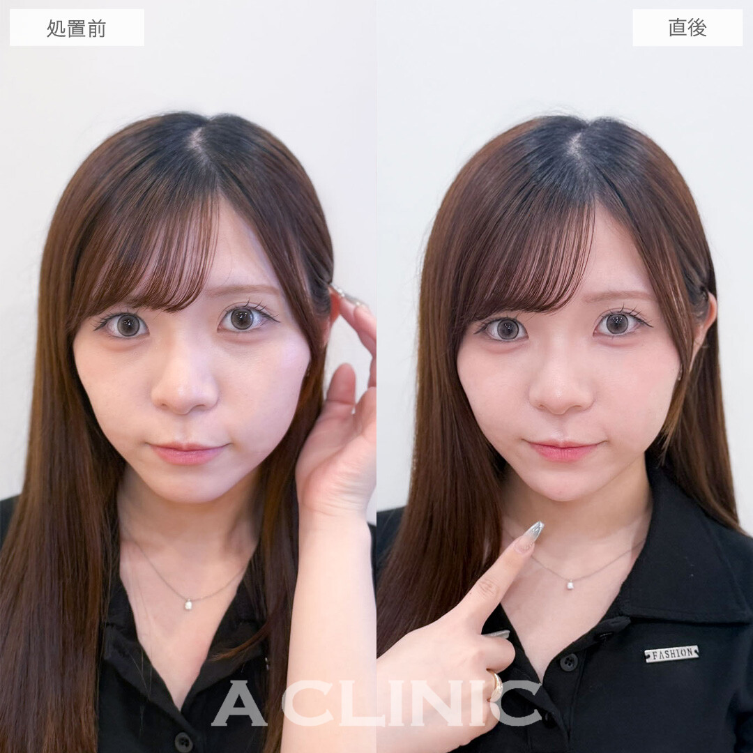 ヒアルロン酸カスタマイズメニューで中顔面の影をリセットしアゴもシャープに整えました！こちら処置前と直後の症例です(20代女性)
