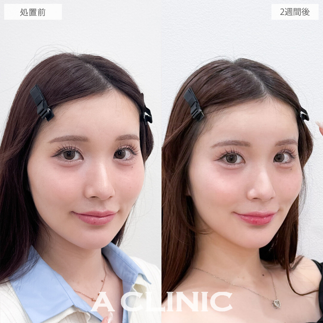 額出しとコメカミ形成(ヒアルロン酸注入)でふんわり丸いおでこになって無敵の可愛さに！こちら処置前と2週間後の症例です(20代女性)