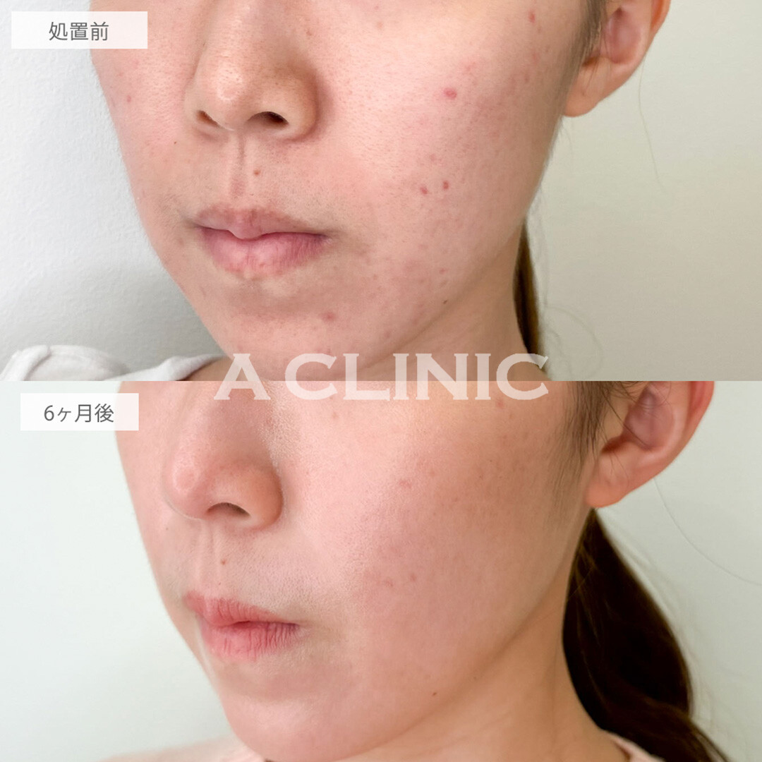 イソトレチノインで新しいニキビができなくなりました！こちら処置前と6ヶ月後の症例です(20代女性)