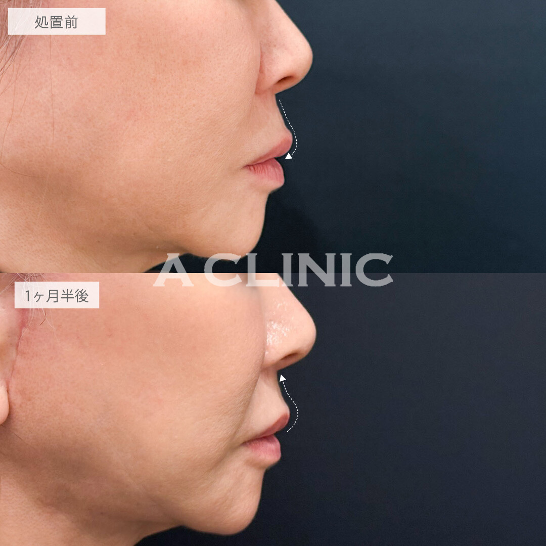 ボトックス注射(人中短縮)とリップヒアルロン酸注入で人中をぐっと短く若返りました！こちら処置前と1ヶ月半後の症例です(60代女性)