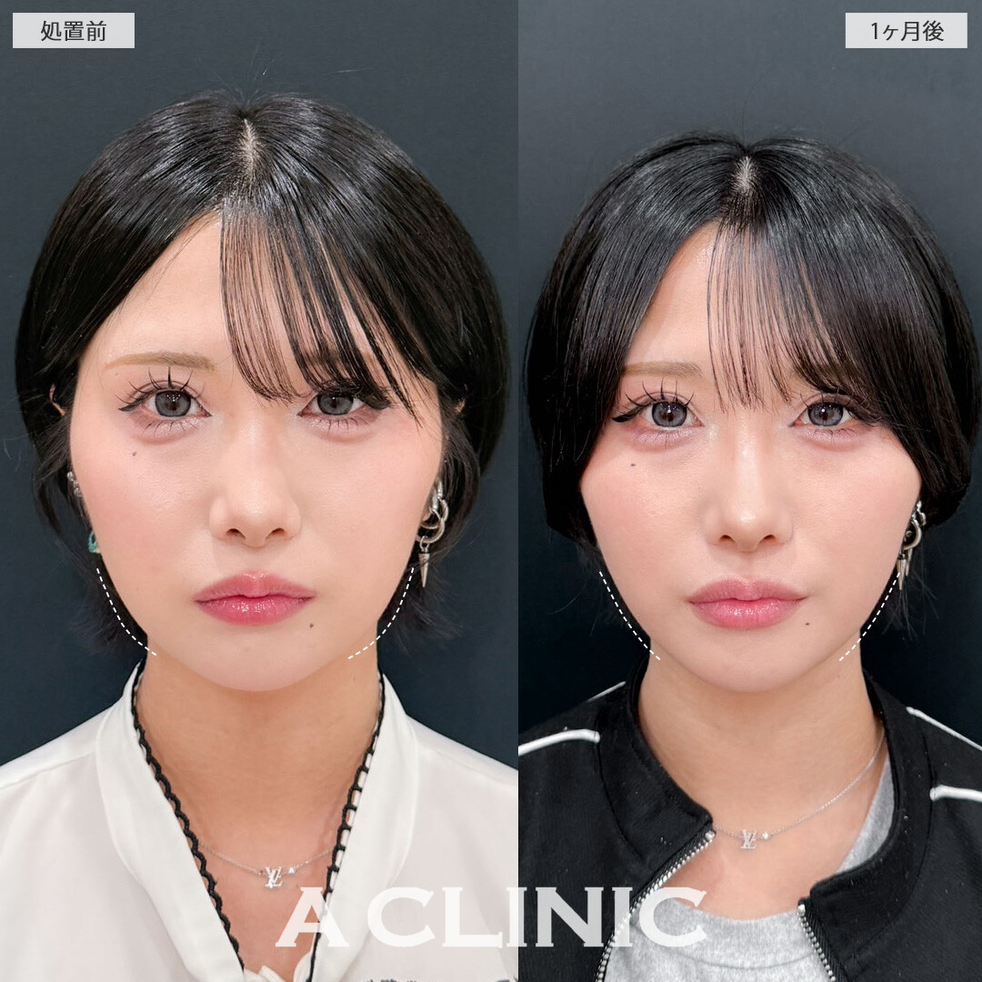 1day小顔脂肪吸引で輪郭をシュッとさせ洗練されたビジュアルに！こちら処置前と1か月後の症例です(20代女性)