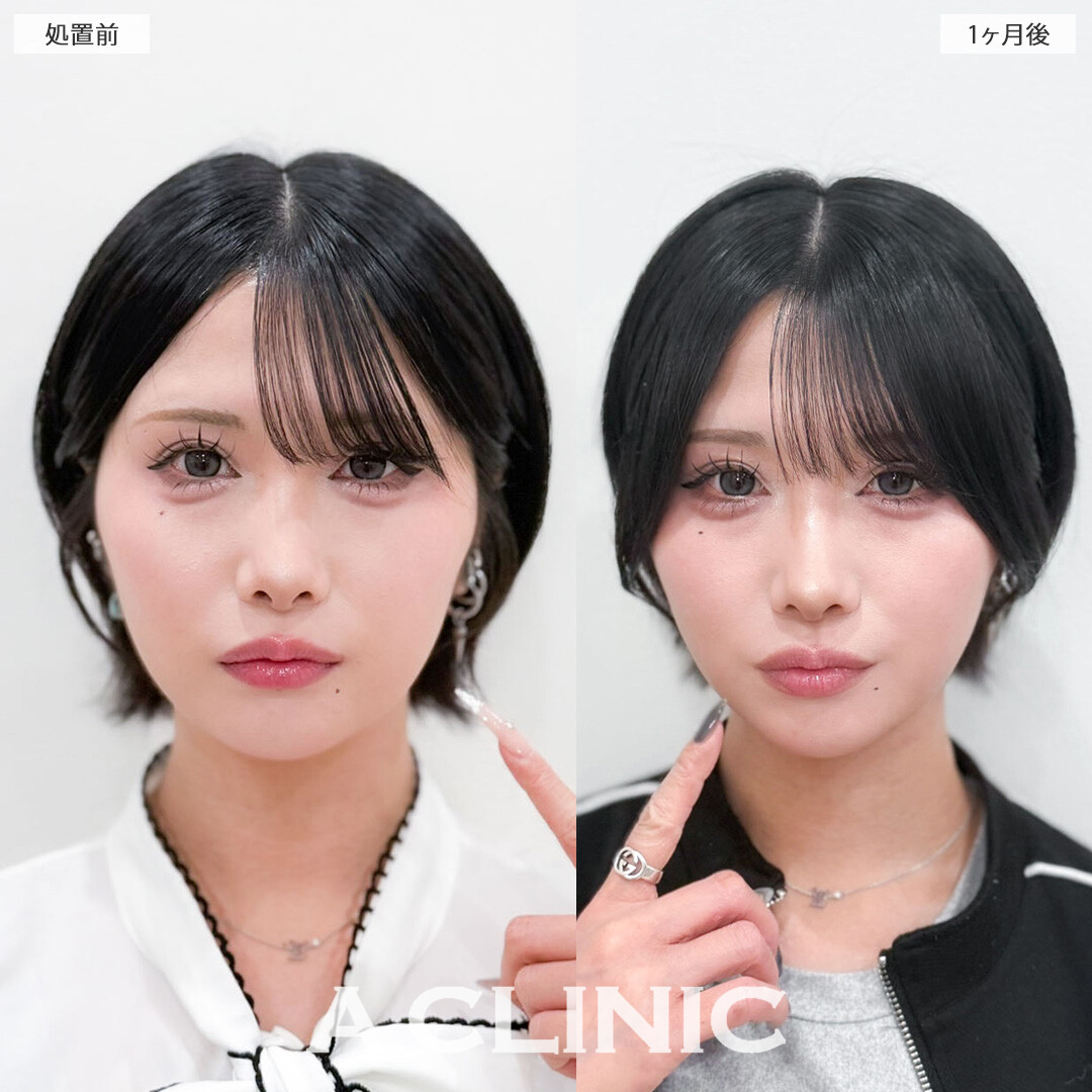 1day小顔脂肪吸引で輪郭をシュッとさせ洗練されたビジュアルに！こちら処置前と1か月後の症例です(20代女性)