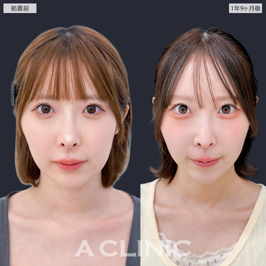 1day小顔脂肪吸引で時間がたっても美しい小顔を維持できます！こちら処置前と1年9ヶ月後の症例です(20代女性)