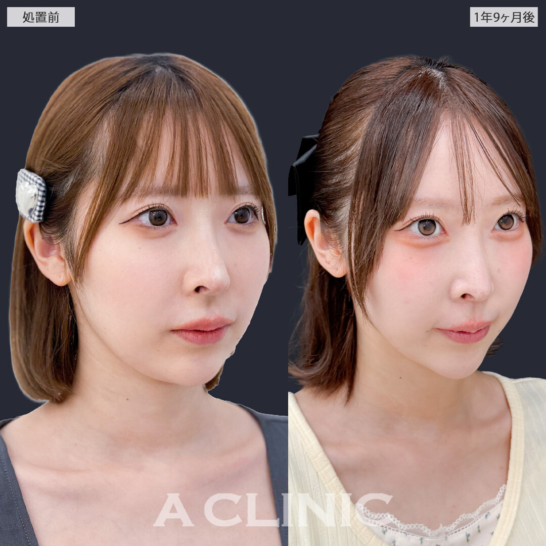 1day小顔脂肪吸引で時間がたっても美しい小顔を維持できます！こちら処置前と1年9ヶ月後の症例です(20代女性)