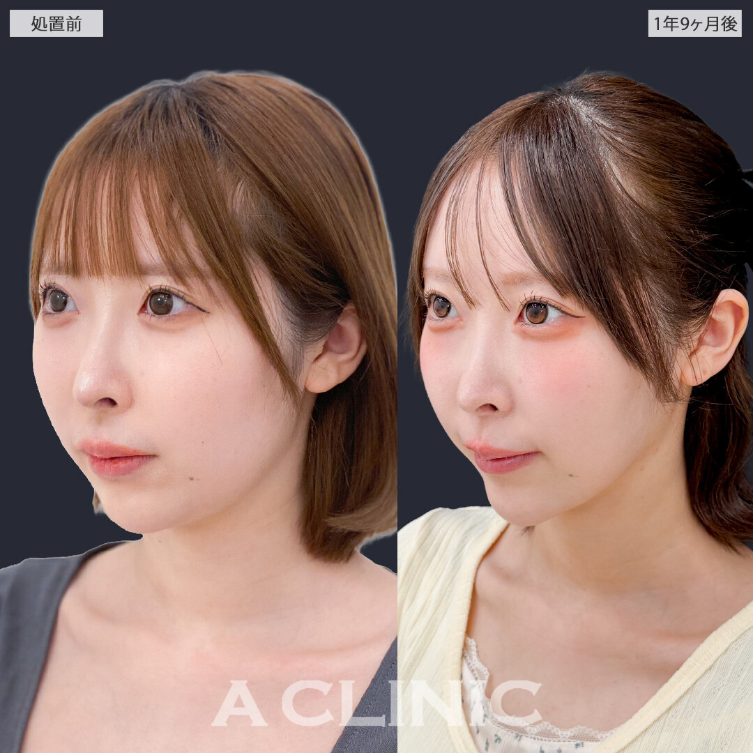 1day小顔脂肪吸引で時間がたっても美しい小顔を維持できます！こちら処置前と1年9ヶ月後の症例です(20代女性)