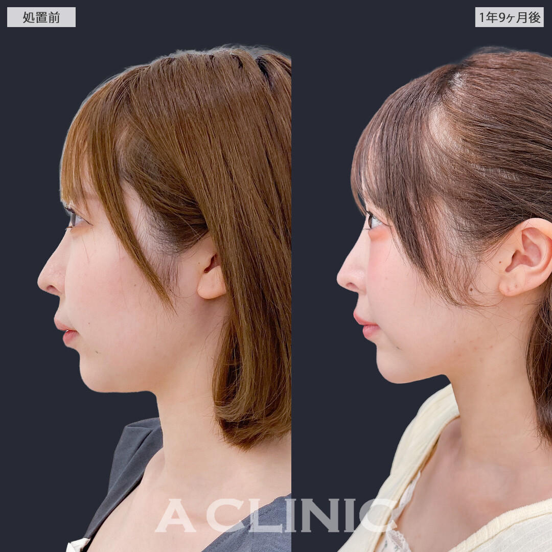 1day小顔脂肪吸引で時間がたっても美しい小顔を維持できます！こちら処置前と1年9ヶ月後の症例です(20代女性)