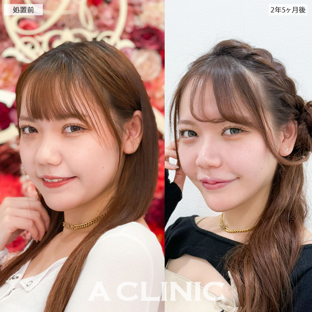 1day小顔脂肪吸引は半永久的に理想の小顔をキープできます！こちら処置前と2年5ヶ月後の症例です(20代女性)