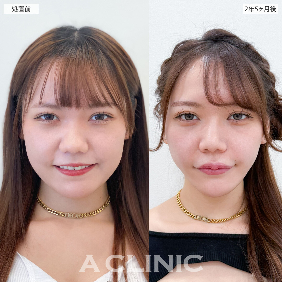1day小顔脂肪吸引は半永久的に理想の小顔をキープできます！こちら処置前と2年5ヶ月後の症例です(20代女性)