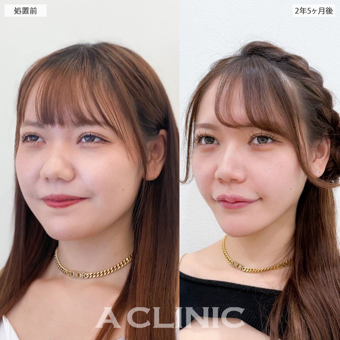 1day小顔脂肪吸引は半永久的に理想の小顔をキープできます！こちら処置前と2年5ヶ月後の症例です(20代女性)