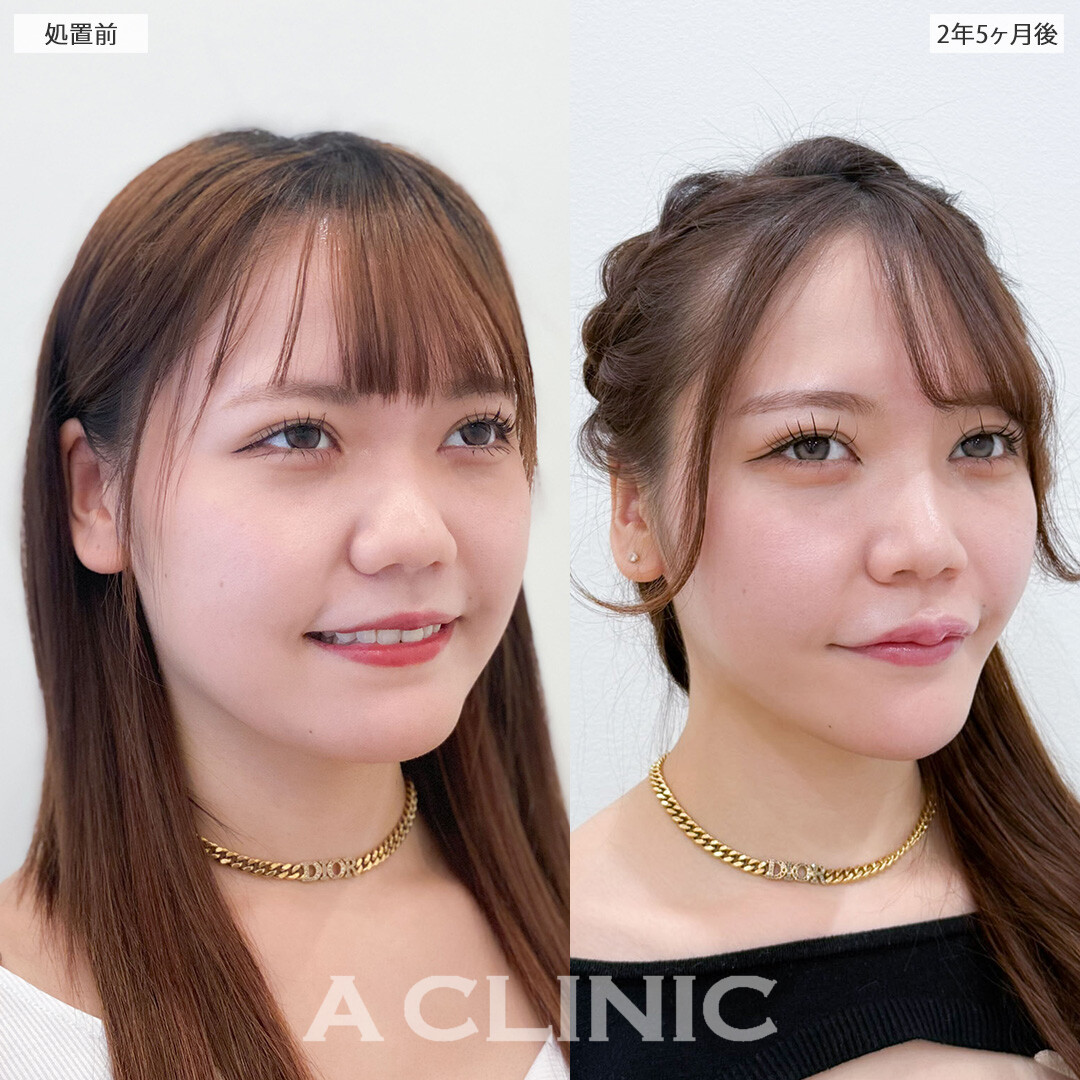 1day小顔脂肪吸引は半永久的に理想の小顔をキープできます！こちら処置前と2年5ヶ月後の症例です(20代女性)