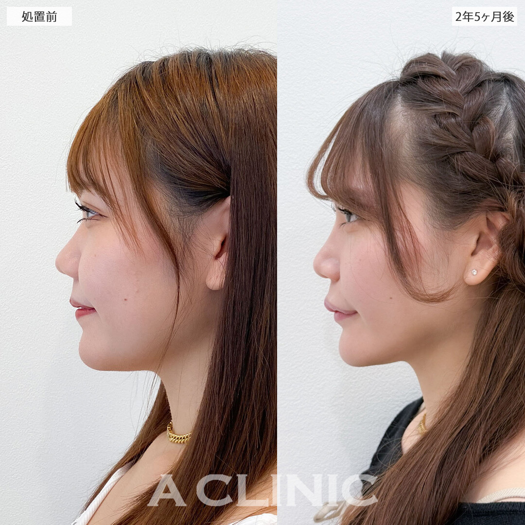 1day小顔脂肪吸引は半永久的に理想の小顔をキープできます！こちら処置前と2年5ヶ月後の症例です(20代女性)