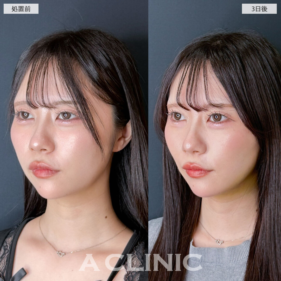 1day小顔脂肪吸引でパーツ際立つあか抜け小顔へ！こちら処置前と3日後の症例です(20代女性)