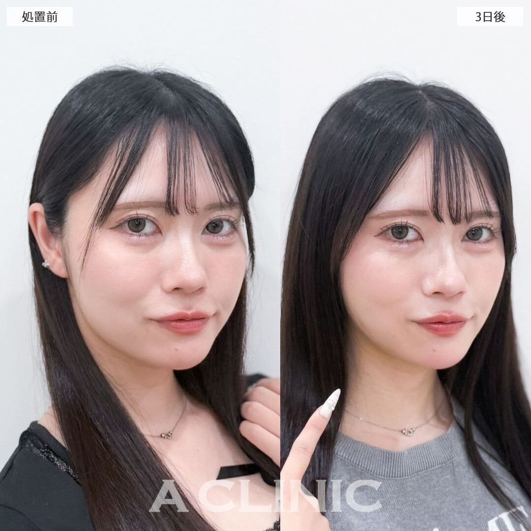 1day小顔脂肪吸引でパーツ際立つあか抜け小顔へ！こちら処置前と3日後の症例です(20代女性)