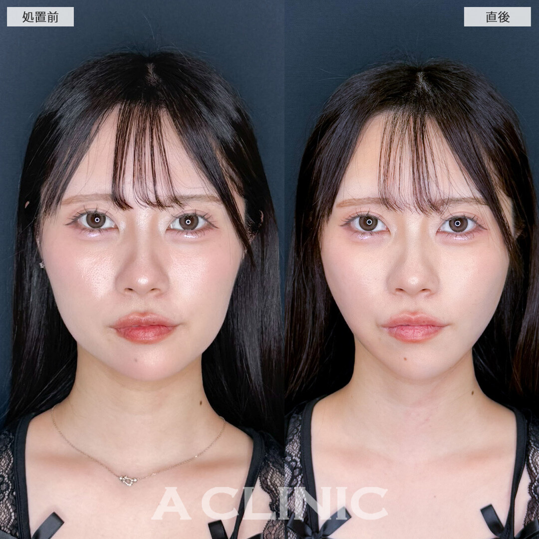 1day小顔脂肪吸引でやりすぎ感ゼロの小顔に大変身！こちら処置前と直後の症例です(20代女性)