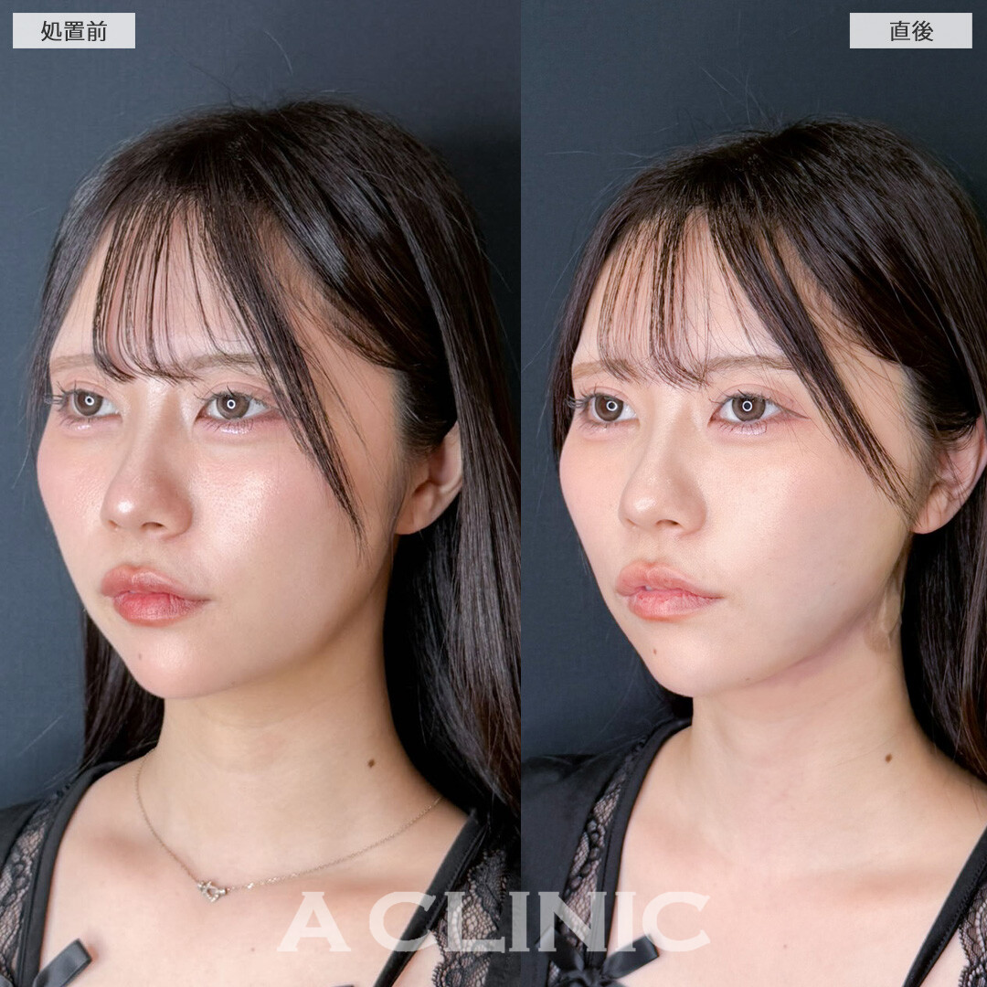 1day小顔脂肪吸引でやりすぎ感ゼロの小顔に大変身！こちら処置前と直後の症例です(20代女性)