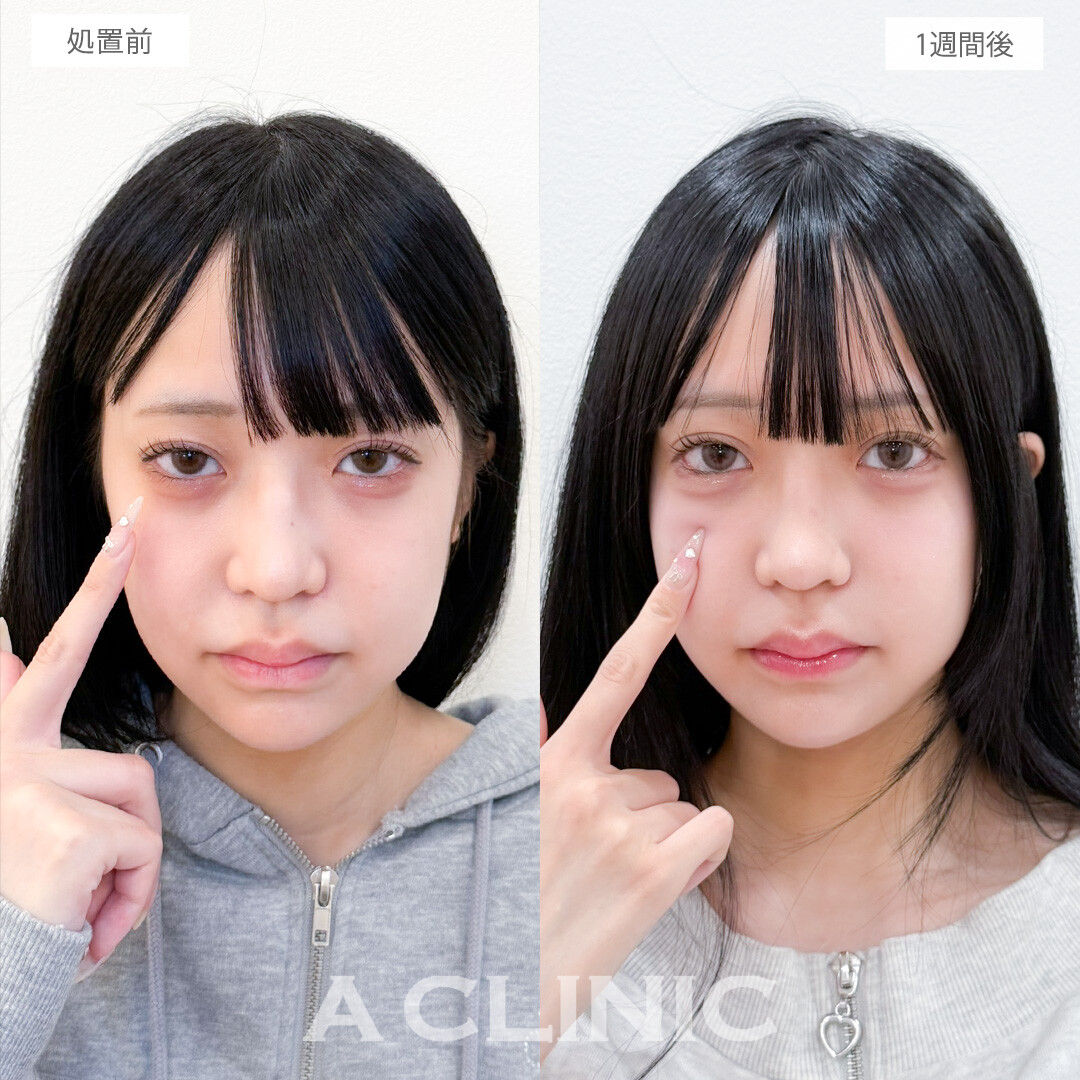 パーフェクトアイズで目の縦幅が広がり目つき改善！処置前と1週間後の症例です(10代女性)