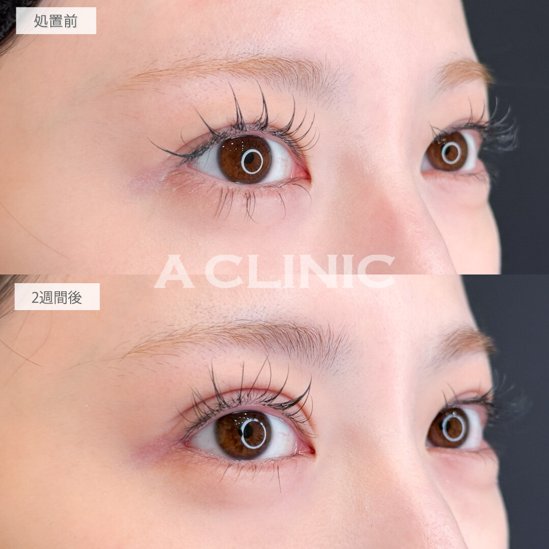 二重術埋没法とパーフェクトアイズの組み合わせで目力アップしつつたれ目で優しい印象の目元に！処置前と2週間後の症例です(20代女性)