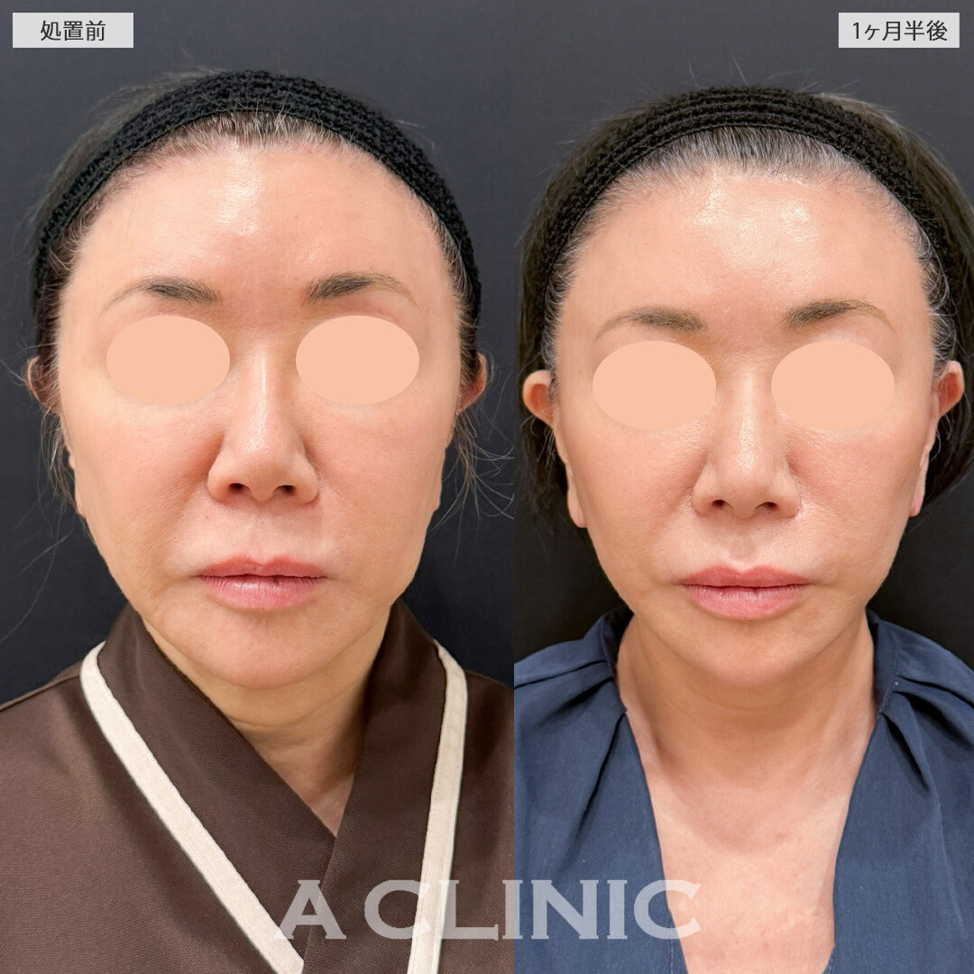 【直後の傷跡あり】A式たるみ切開と1day小顔脂肪吸引で口元のたるみと頬の重みを同時に整え若返りました！こちら処置前と1ヶ月半後の症例です(60代女性)