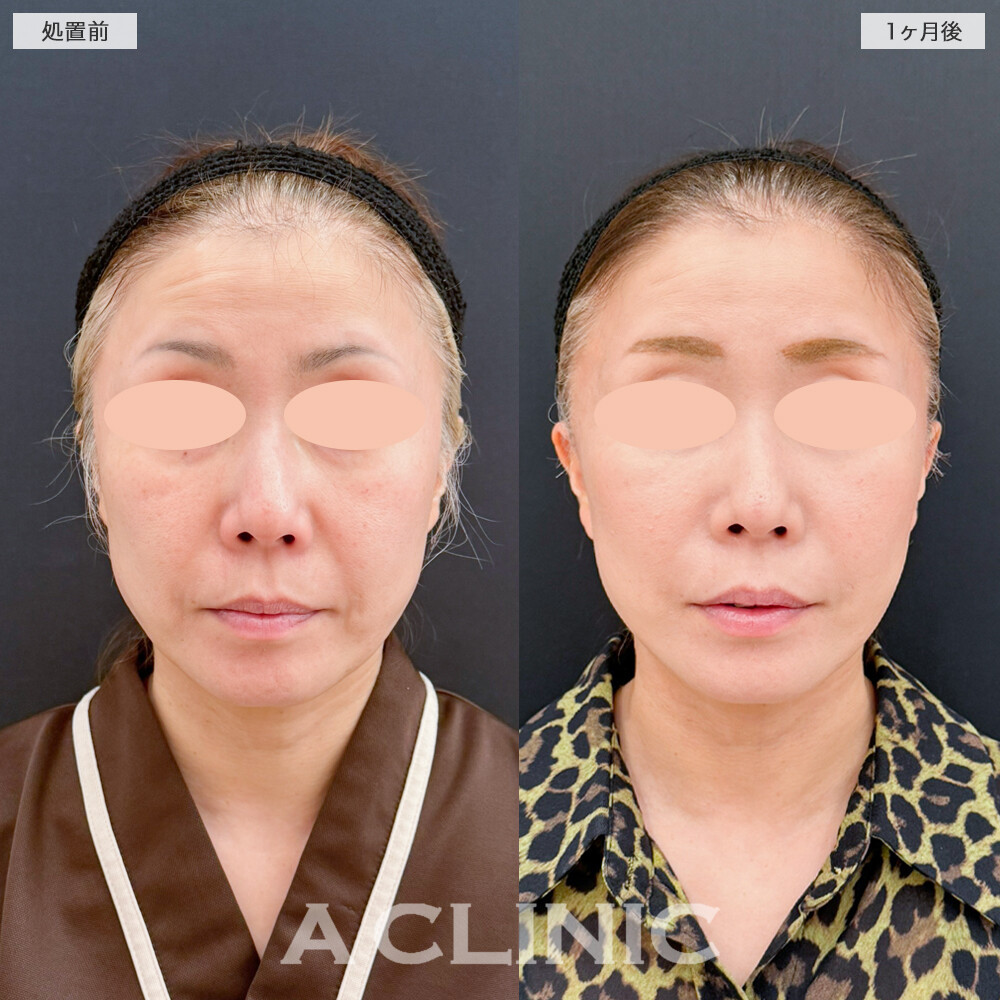 A式たるみ切開でフェイスラインを根本から引き上げ！処置前と1ヶ月後の症例です(40代女性)