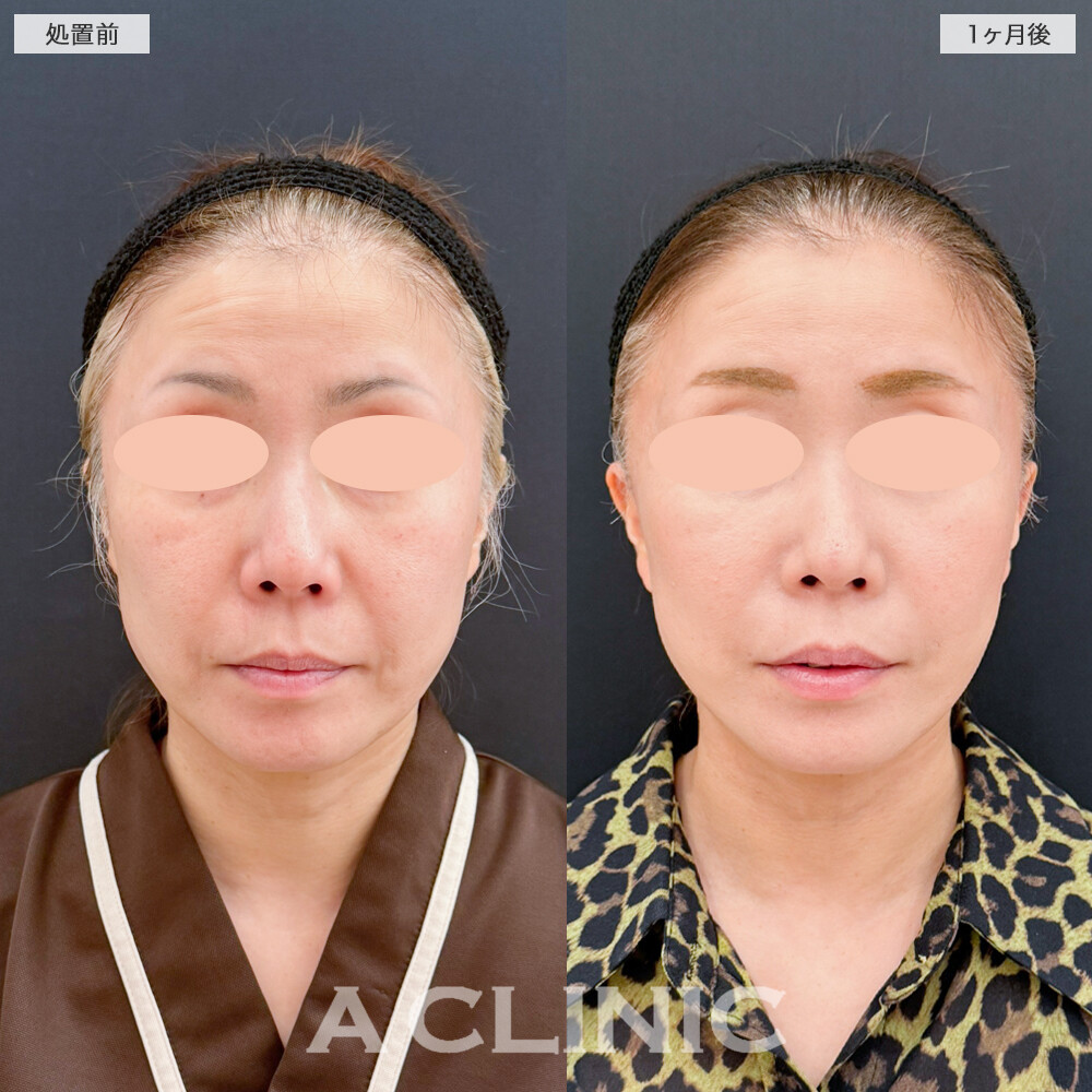 A式たるみ切開でフェイスラインを根本から引き上げ！処置前と1ヶ月後の症例です(40代女性)