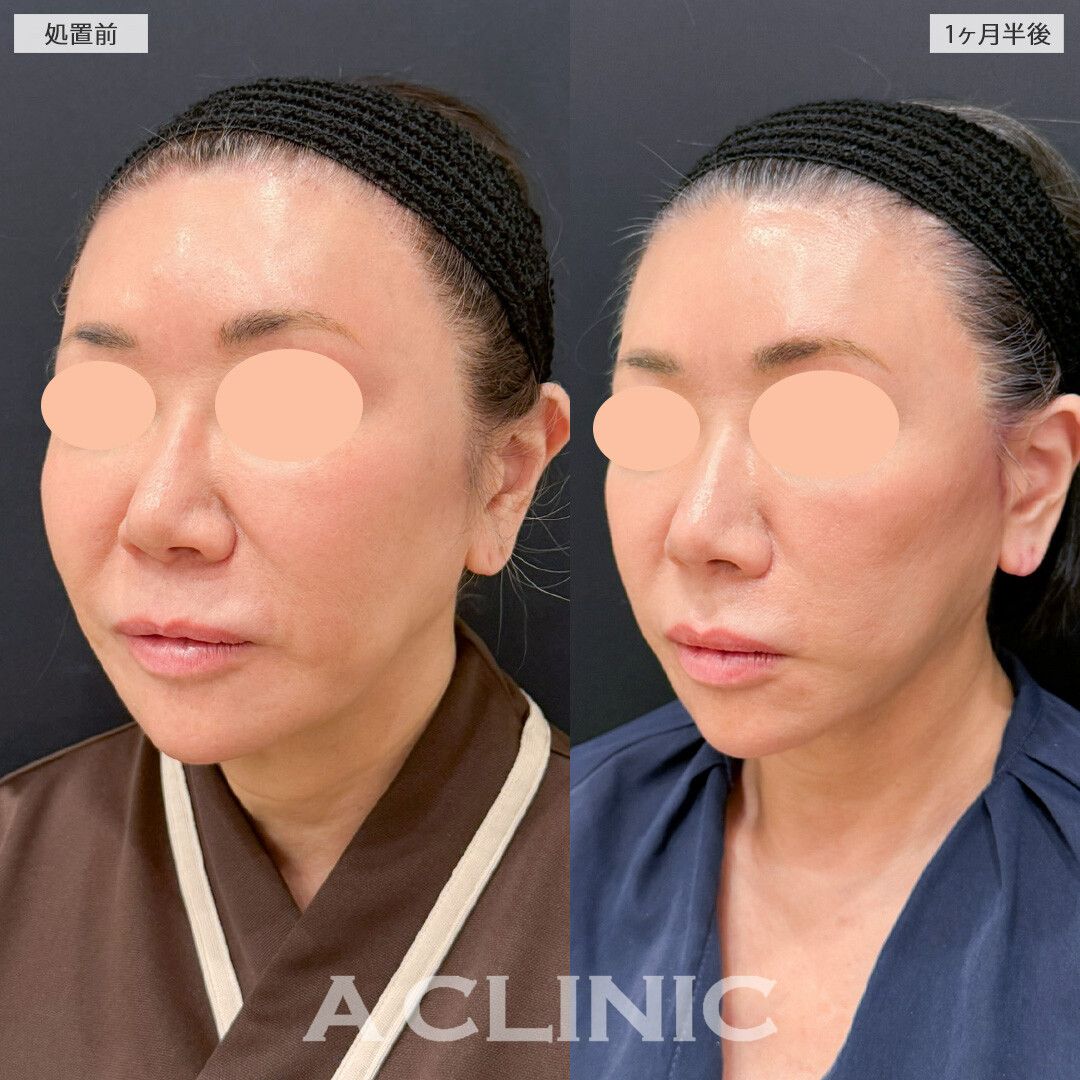 【直後の傷跡あり】A式たるみ切開と1day小顔脂肪吸引で口元のたるみと頬の重みを同時に整え若返りました！こちら処置前と1ヶ月半後の症例です(60代女性)