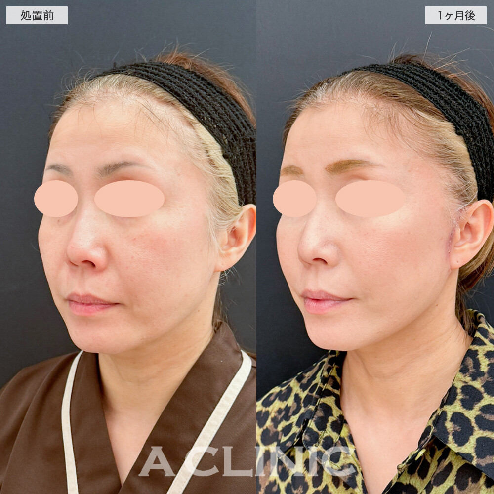 A式たるみ切開でフェイスラインを根本から引き上げ！処置前と1ヶ月後の症例です(40代女性)