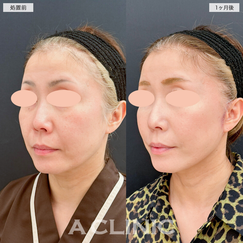 A式たるみ切開でフェイスラインを根本から引き上げ！処置前と1ヶ月後の症例です(40代女性)