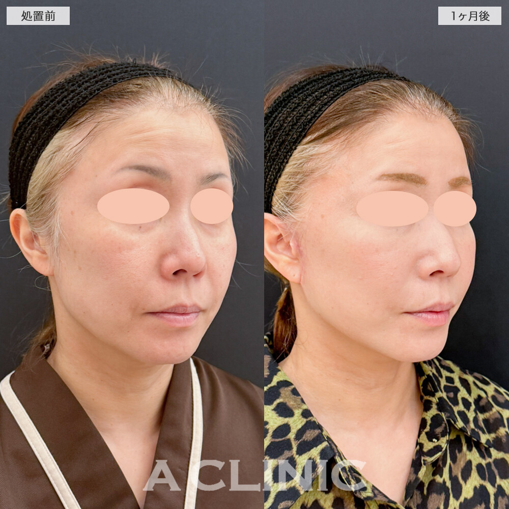 A式たるみ切開でフェイスラインを根本から引き上げ！処置前と1ヶ月後の症例です(40代女性)