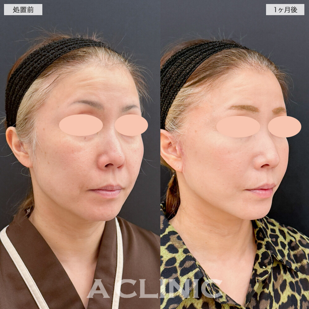 A式たるみ切開でフェイスラインを根本から引き上げ！処置前と1ヶ月後の症例です(40代女性)