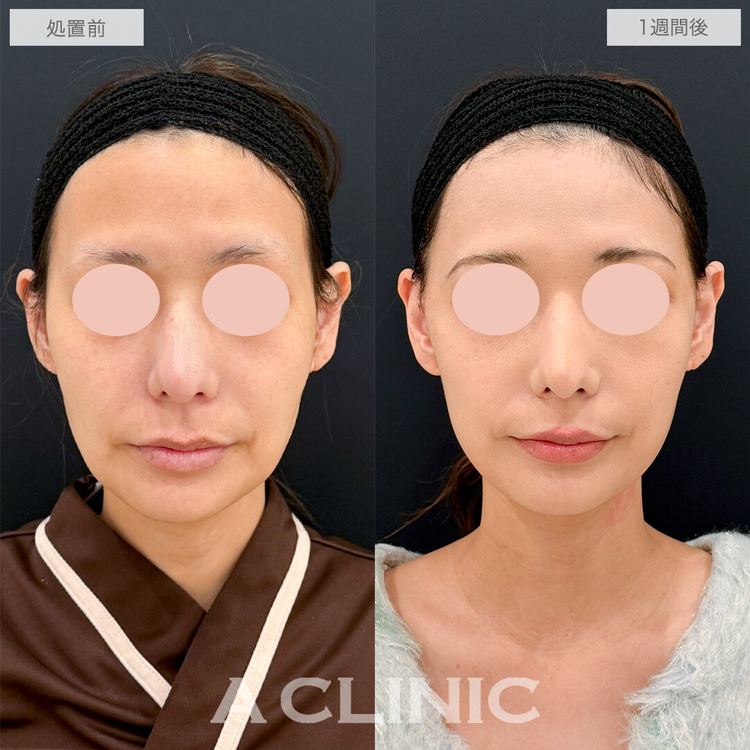 A式たるみ切開でつるんと若々しいフェイスラインに！処置前と1週間後の症例です(40代女性)