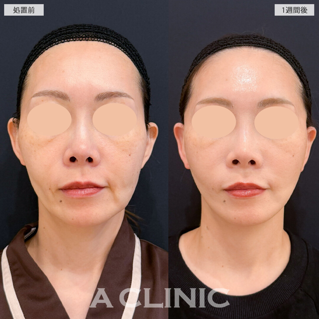 【直後の傷跡あり】A式たるみ切開でもたつく輪郭をすっきりリセット！こちら処置前と1週間後の症例です(40代女性)
