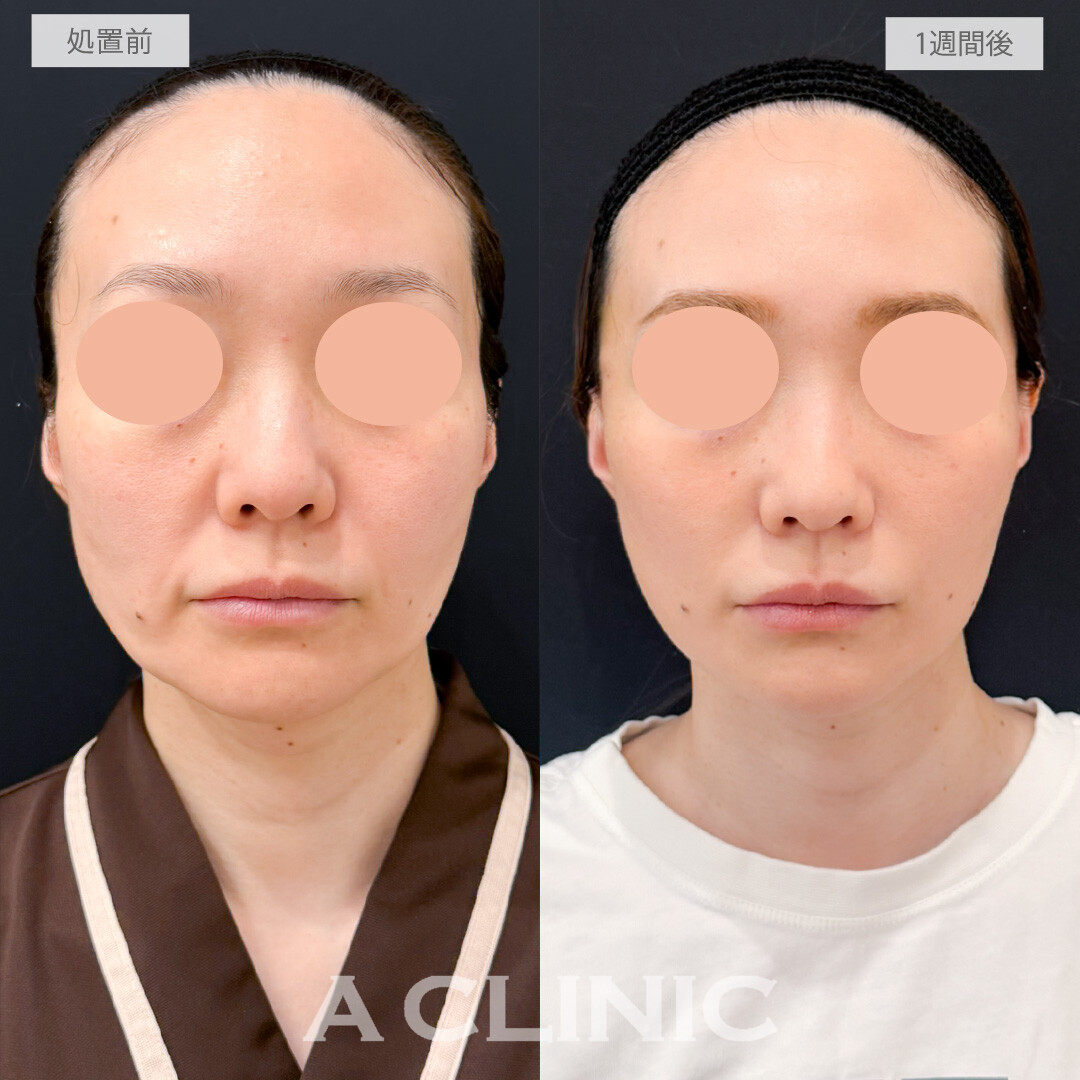 A式たるみ切開でナチュラルな若返りもできます！処置前と1週間後の症例です(40代女性)