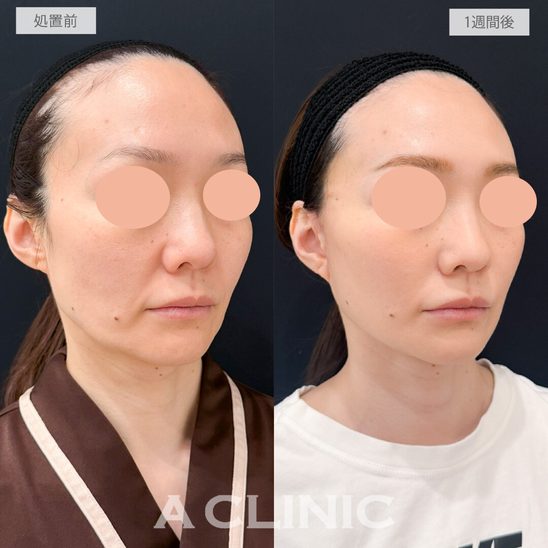 A式たるみ切開でナチュラルな若返りもできます！処置前と1週間後の症例です(40代女性)