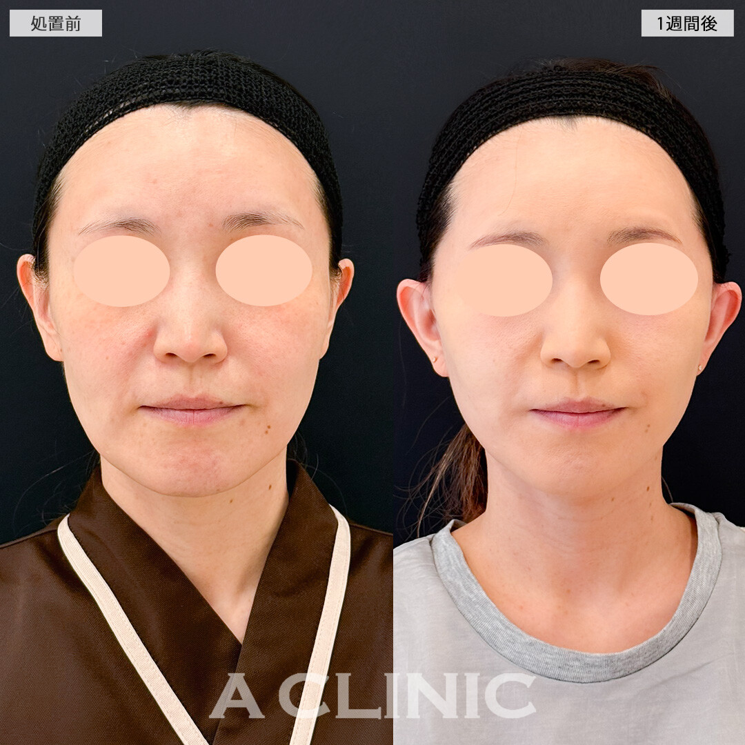 A式たるみ切開と立ち耳ヒアルロン酸注入(ボリューマ)で若々しさと小顔効果抜群！処置前と1週間後の症例です(40代女性)