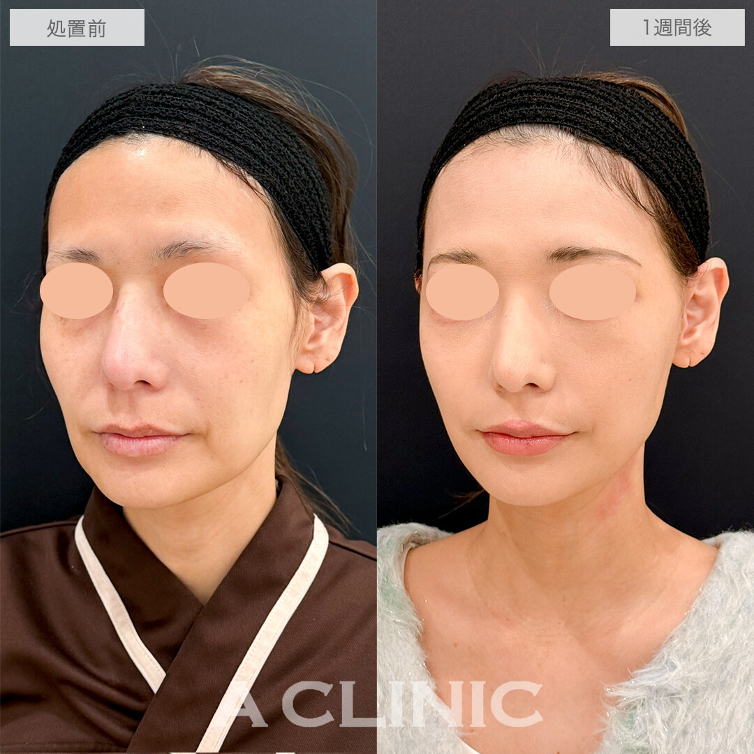 A式たるみ切開でつるんと若々しいフェイスラインに！処置前と1週間後の症例です(40代女性)