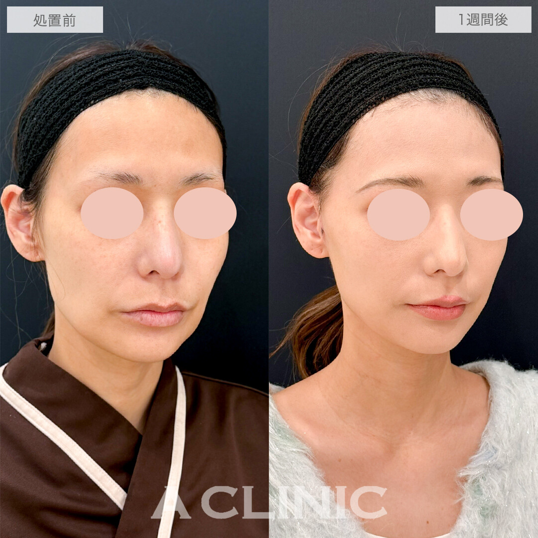 A式たるみ切開でつるんと若々しいフェイスラインに！処置前と1週間後の症例です(40代女性)