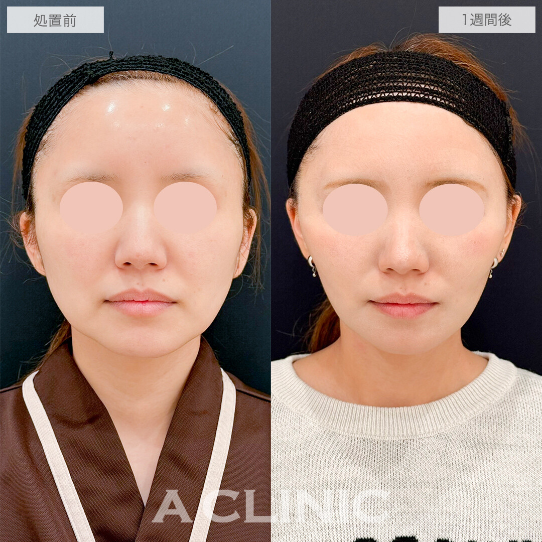 A式たるみ切開と1day小顔脂肪吸引で若返りも小顔も叶う！処置前と1週間後の症例です(40代女性)