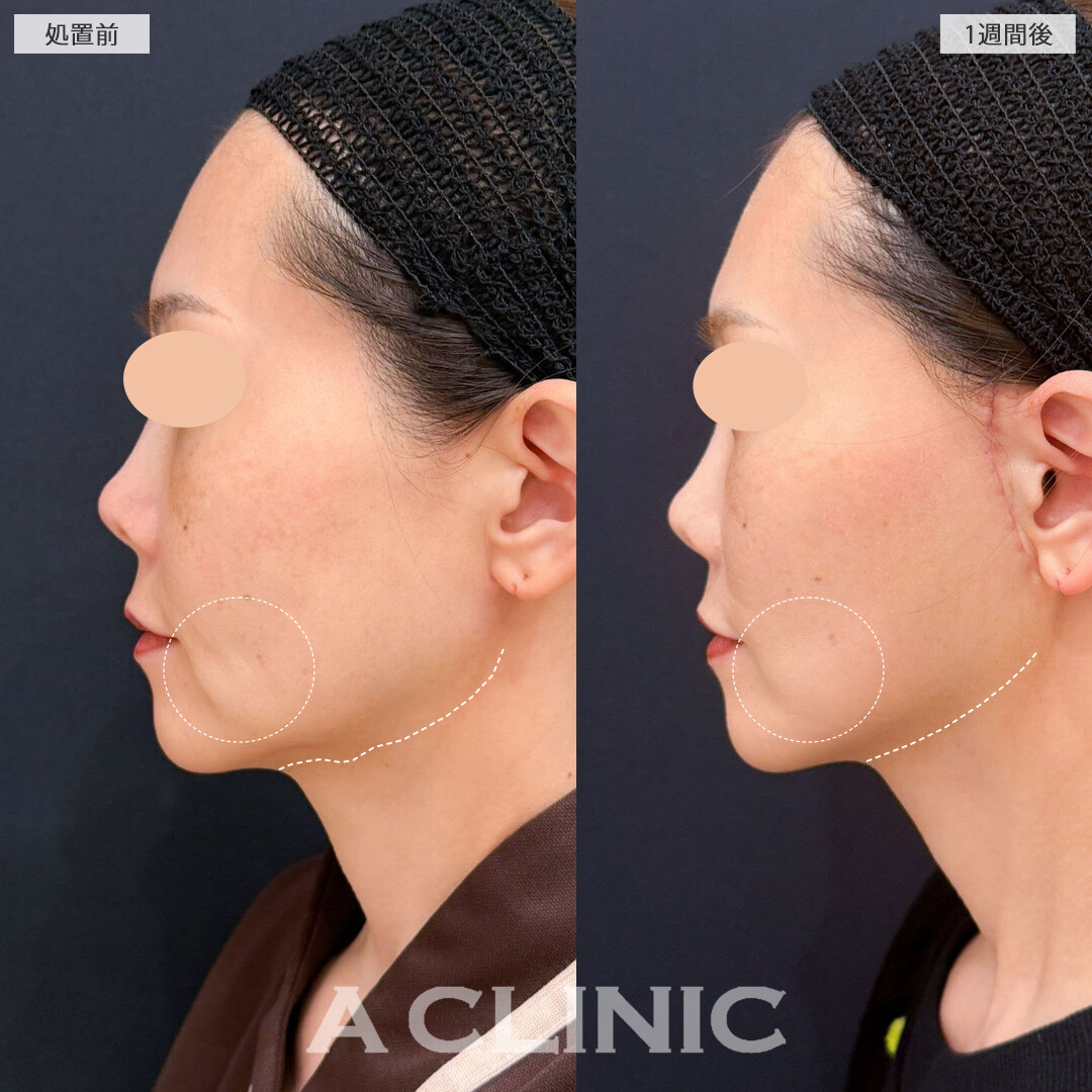【直後の傷跡あり】A式たるみ切開でもたつく輪郭をすっきりリセット！こちら処置前と1週間後の症例です(40代女性)