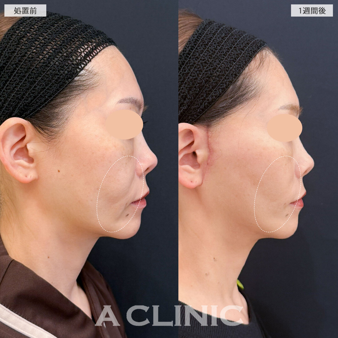 【直後の傷跡あり】A式たるみ切開でもたつく輪郭をすっきりリセット！こちら処置前と1週間後の症例です(40代女性)