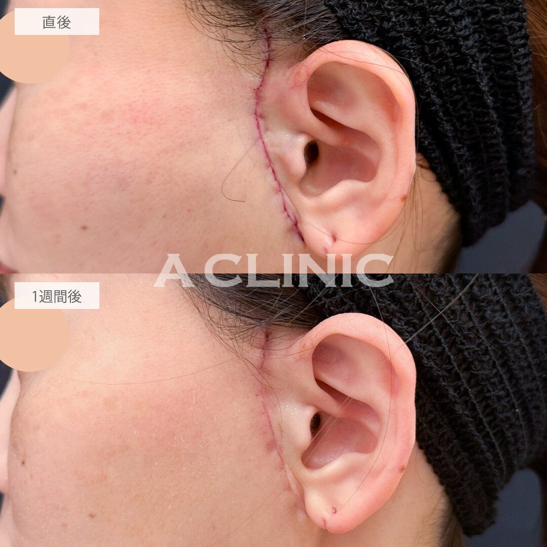 【直後の傷跡あり】A式たるみ切開でもたつく輪郭をすっきりリセット！こちら処置前と1週間後の症例です(40代女性)