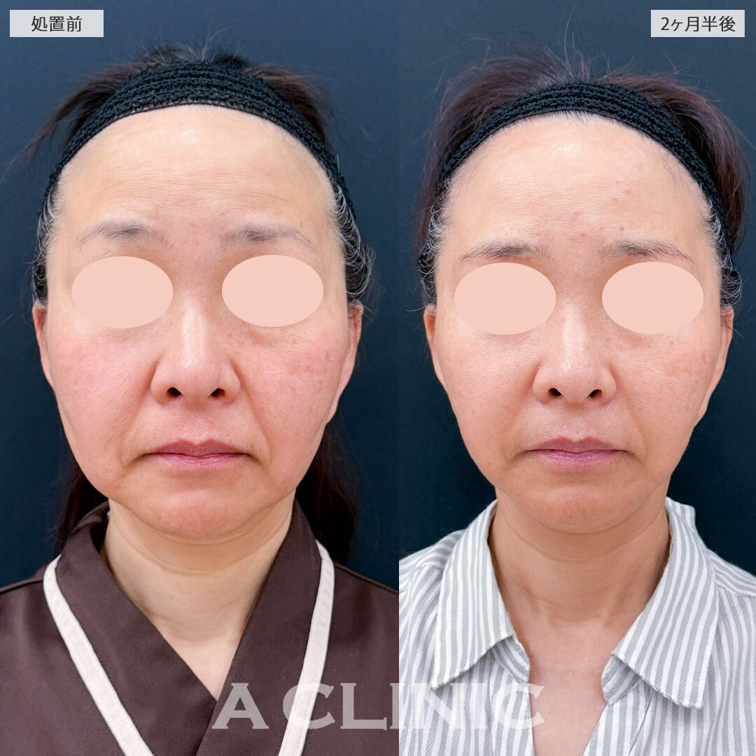 【直後の傷跡有り】1day小顔脂肪吸引とA式たるみ切開でたるみを自然に引き上げ若々しくリセット！こちら処置前と2ヶ月半後の症例です(50代女性)