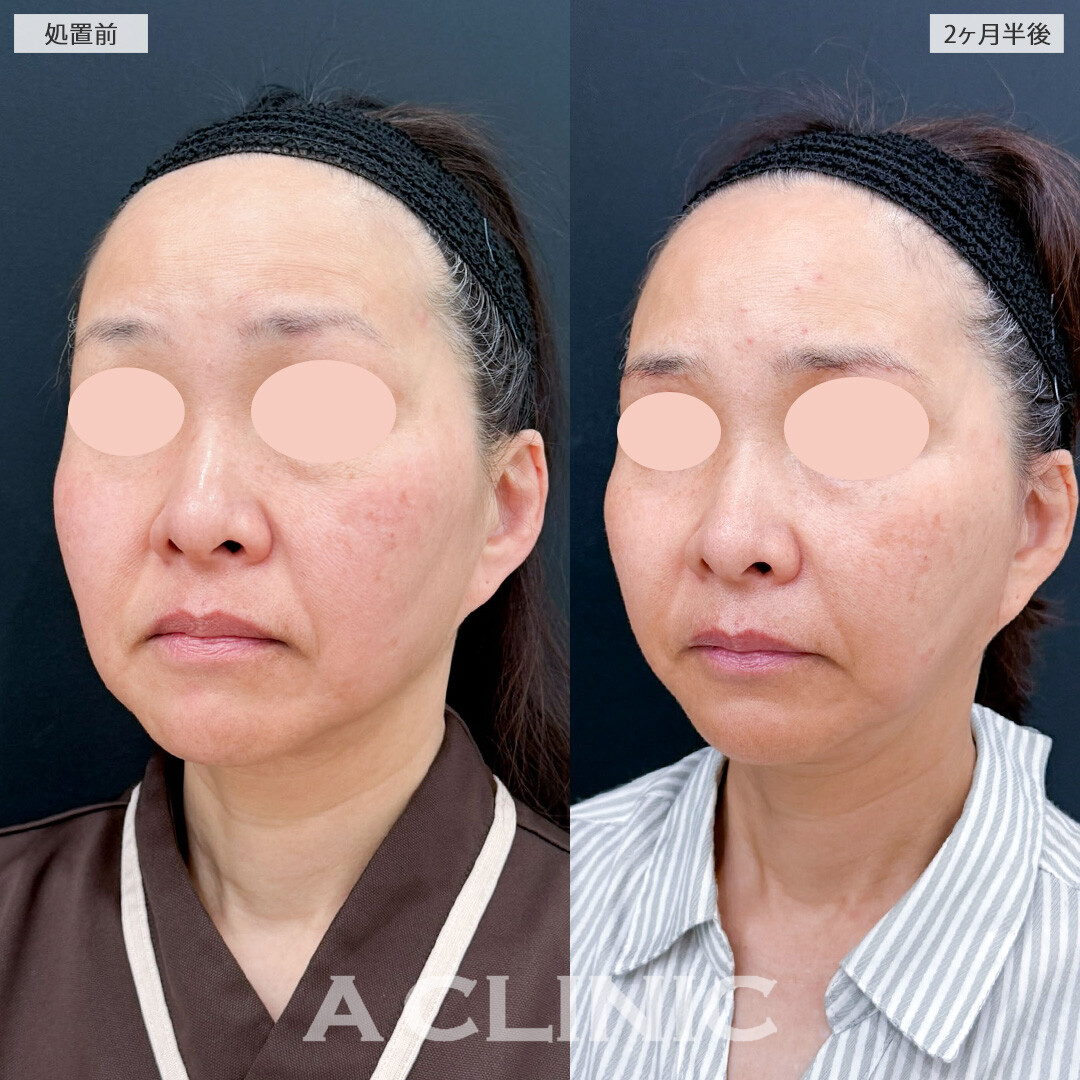 【直後の傷跡有り】1day小顔脂肪吸引とA式たるみ切開でたるみを自然に引き上げ若々しくリセット！こちら処置前と2ヶ月半後の症例です(50代女性)