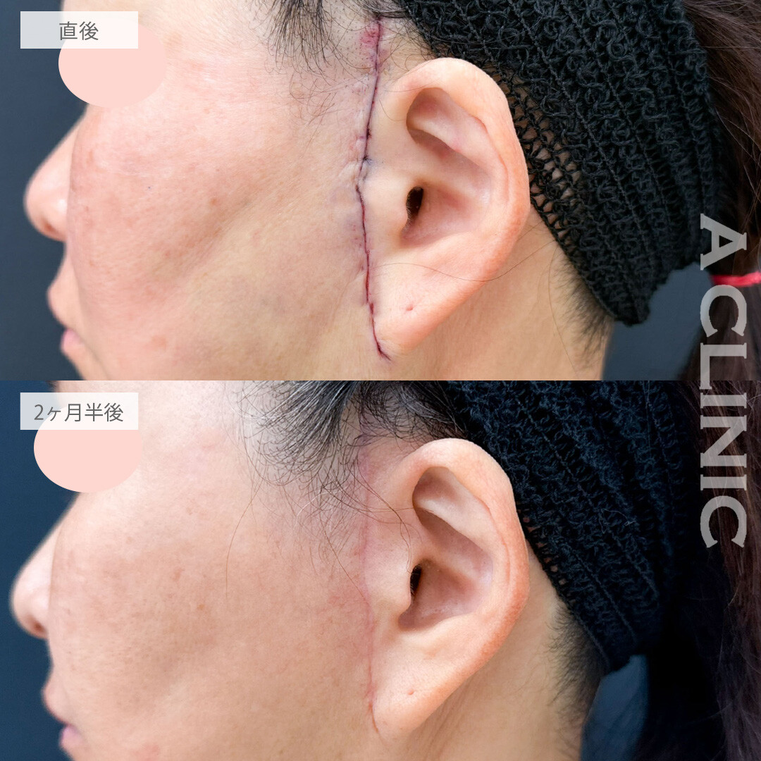 【直後の傷跡有り】1day小顔脂肪吸引とA式たるみ切開でたるみを自然に引き上げ若々しくリセット！こちら処置前と2ヶ月半後の症例です(50代女性)