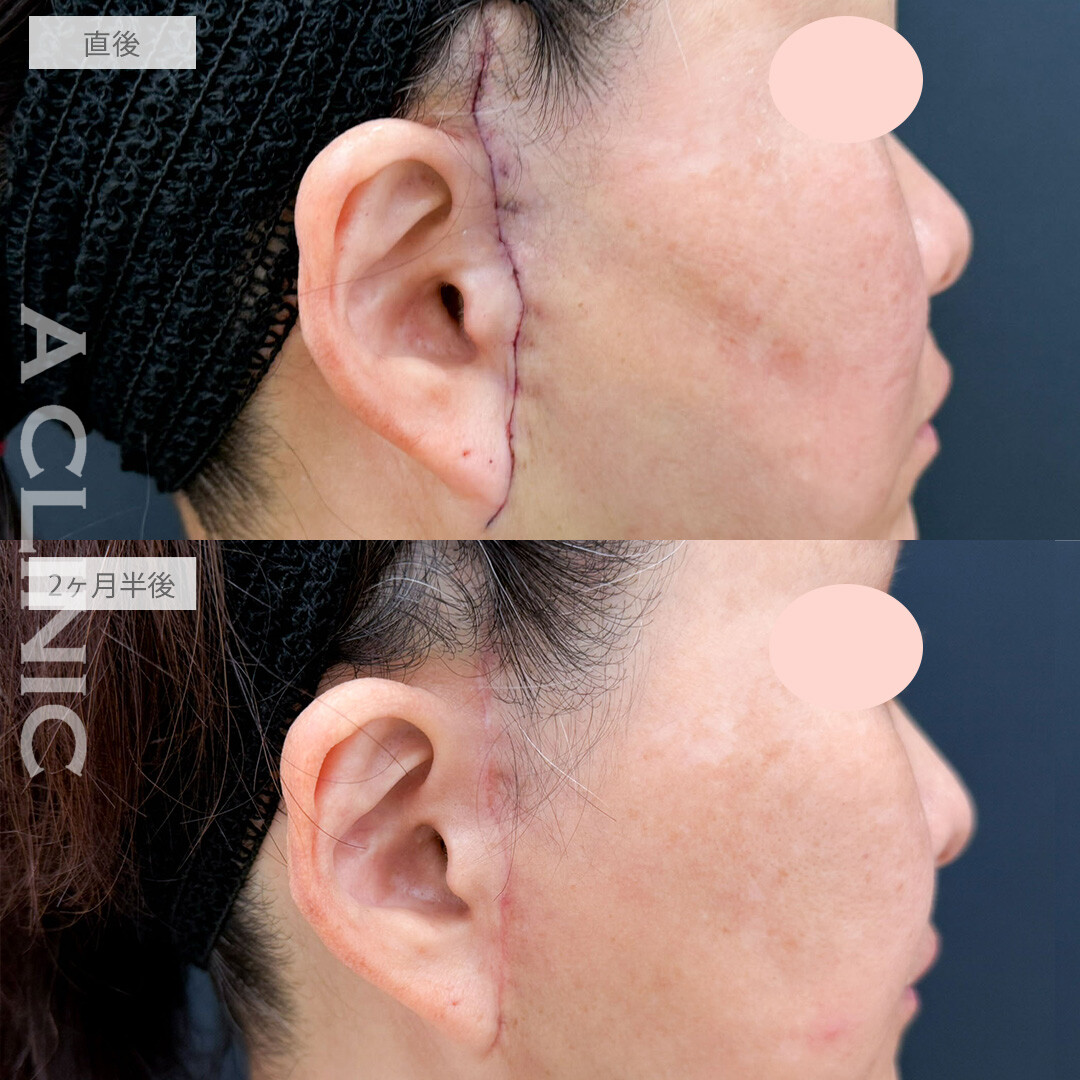 【直後の傷跡有り】1day小顔脂肪吸引とA式たるみ切開でたるみを自然に引き上げ若々しくリセット！こちら処置前と2ヶ月半後の症例です(50代女性)