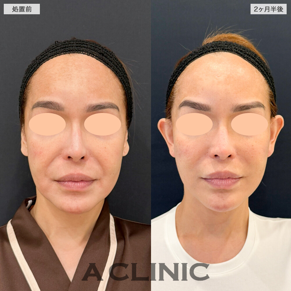 A式ナゾラリフトでほうれい線が改善し、自然な若返りを実現！処置前と2ヶ月半後の症例です(40代女性)