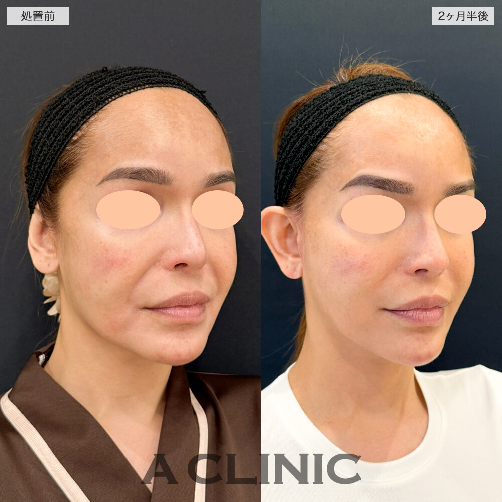 A式ナゾラリフトでほうれい線が改善し自然な若返りを実現！処置前と2ヶ月半後の症例です(40代女性)